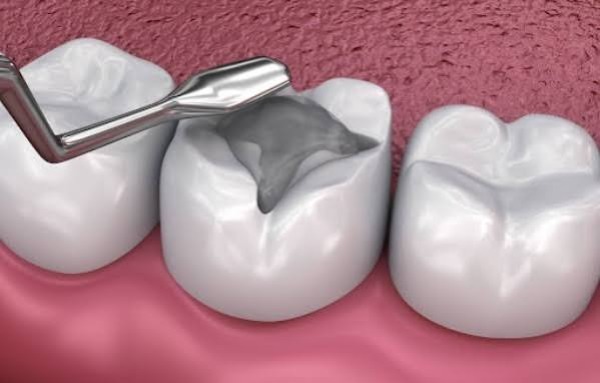 Tại sao miếng trám răng bị bong tróc?