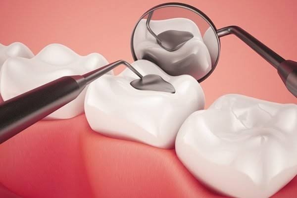 Nên chọn amalgam hay composite?