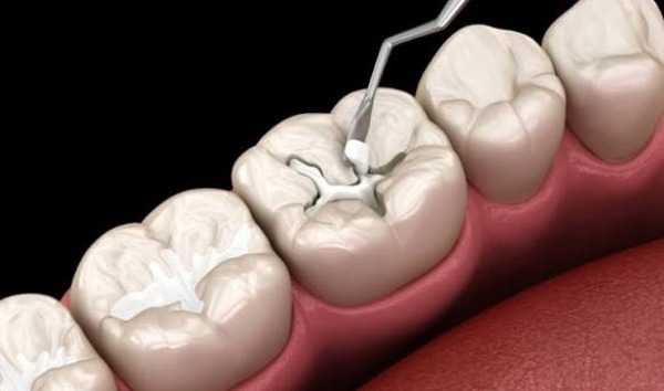 Amalgam là gì và chứa những gì?