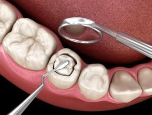 Trám răng bị bong tróc và cách xử lý sớm để tránh sâu