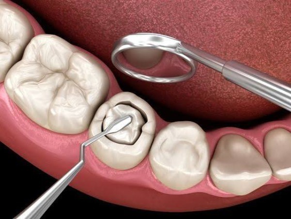 Trám răng bị bong tróc và cách xử lý sớm để tránh sâu