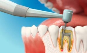 Lấy tủy răng có ảnh hưởng đến khả năng ăn uống không?
