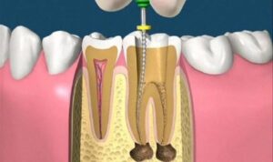 Sau lấy tủy nên kiêng ăn gì để bảo vệ răng