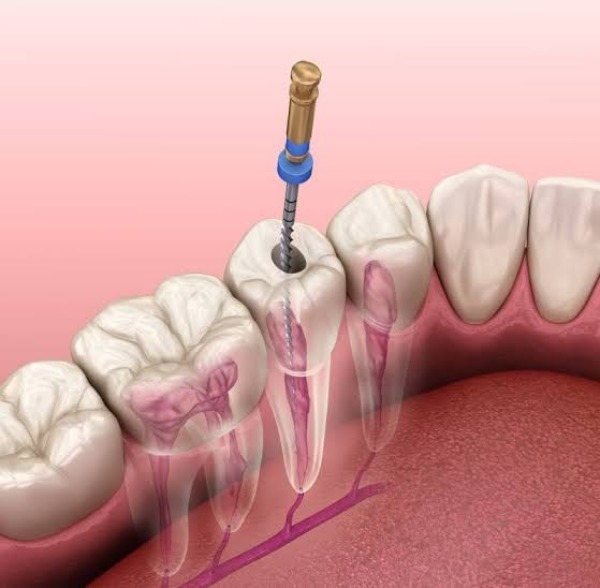 Thuốc diệt tủy răng độc hại như thế nào? Cách dùng an toàn