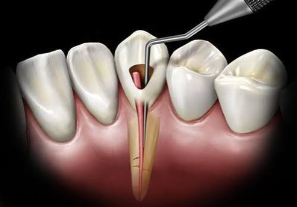 Tủy răng có vai trò gì, tại sao cần lấy