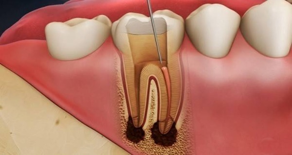 Thuốc diệt tủy răng chứa những thành phần nào