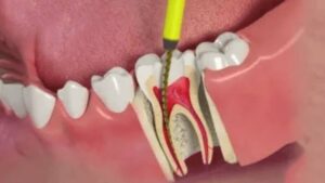 Lấy tủy răng xong bao lâu mới ăn được bình thường?