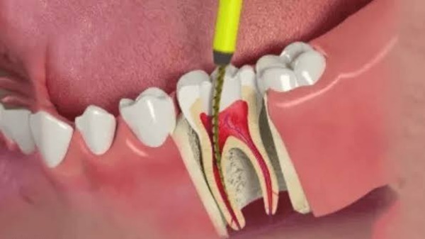 Lấy tủy răng xong bao lâu mới ăn được bình thường?