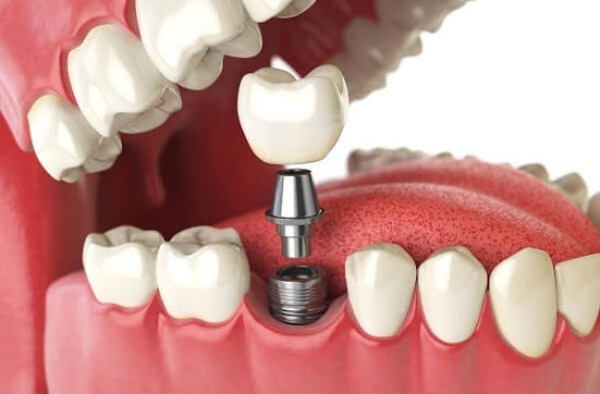 Vì sao phải kiêng ăn sau cấy implant?
