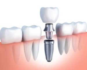 Kiêng ăn gì sau khi cấy ghép implant: Hướng dẫn 4 tuần phục hồi