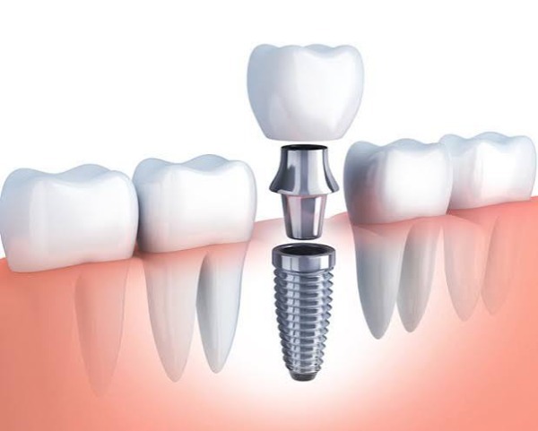Kiêng ăn gì sau khi cấy ghép implant: Hướng dẫn 4 tuần phục hồi