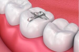 Trám amalgam có độc hại không? Sự thật từ FDA, WHO, ADA