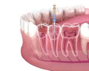 Lấy tủy răng sống khác gì tủy chết? Sự khác biệt quan trọng cần biết