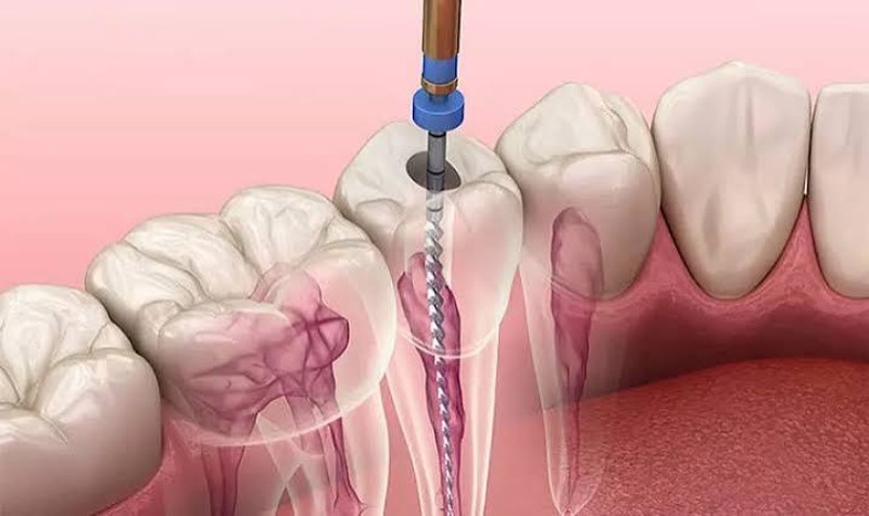 Có phải xử lý ngay khi phát hiện vỡ không?