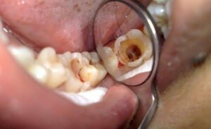 Lấy tủy xong răng bị vỡ phải làm sao? Hướng xử lý khẩn cấp