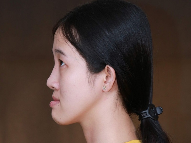 Mặt hình lưỡi cày là khuôn mặt không đẹp, ảnh hưởng đến hiệu quả thẩm mỹ