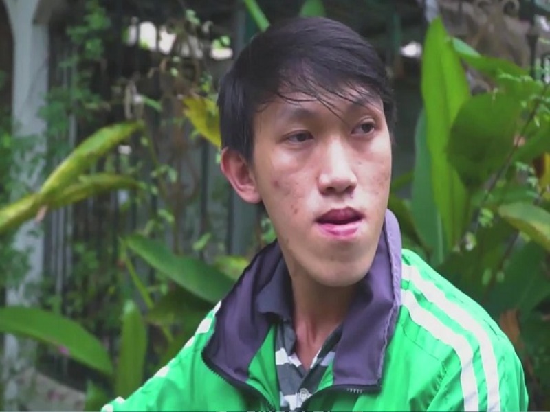 Mặt có hình lưỡi cày là nguyên nhân gây ra tình trạng sai lệch khớp cắn nghiêm trọng