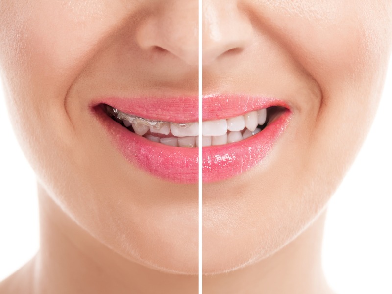 Niềng răng là giải pháp tối ưu đối với những người có tướng mặt lưỡi cày