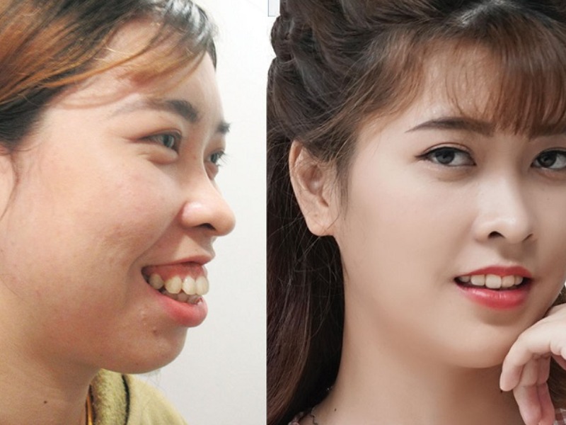 Gọt cằm sẽ giúp gương mặt có được tỷ lệ chuẩn, cân đối và tinh tế hơn