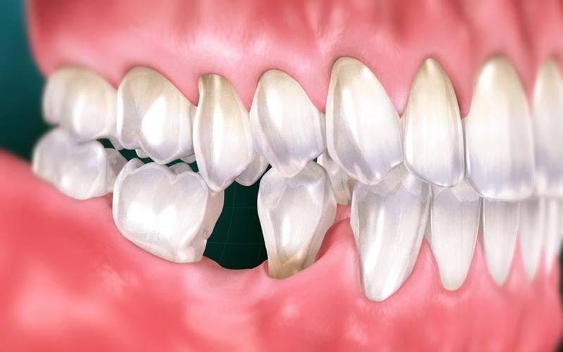 Mất răng vĩnh viễn khiến hàm co lại, dẫn đến tình trạng móm
