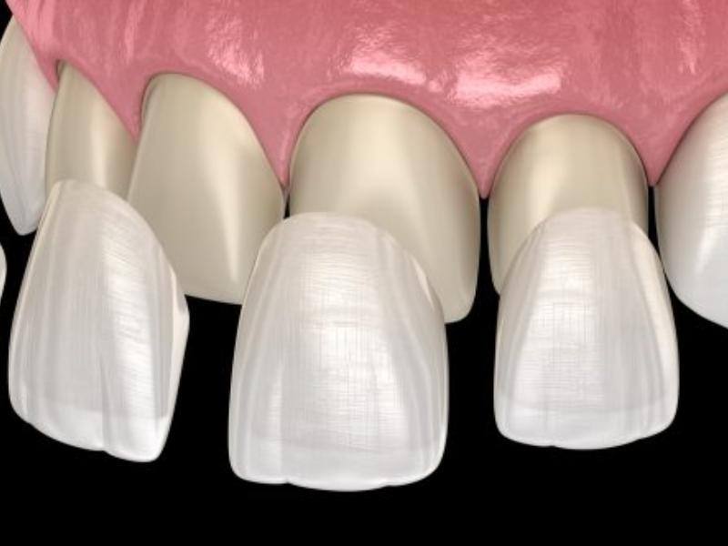 Mặt móm khắc phục như thế nào? Bọc răng sứ khắc phục hiệu quả tình trạng mặt móm nhẹ