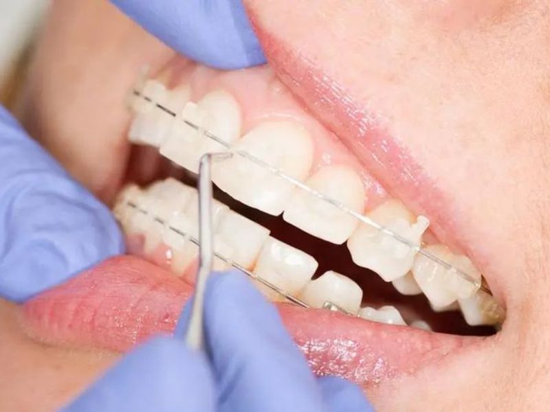 Sau khi nhận thấy 2 hàm đã về đúng vị trí, bác sĩ sẽ chỉ định tháo niềng