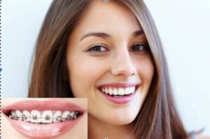 Niềng răng hóp thái dương có sao không? Nguyên nhân do đâu?