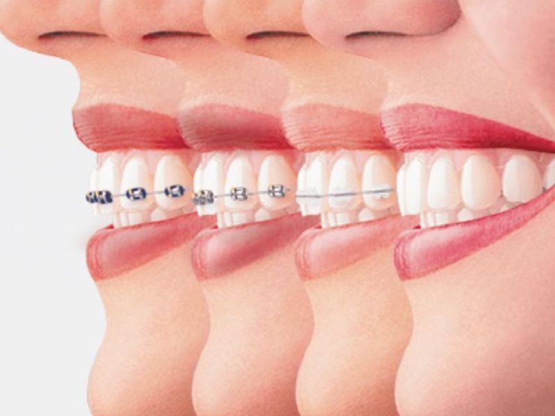 Thời gian niềng răng thường từ 12 - 24 tháng