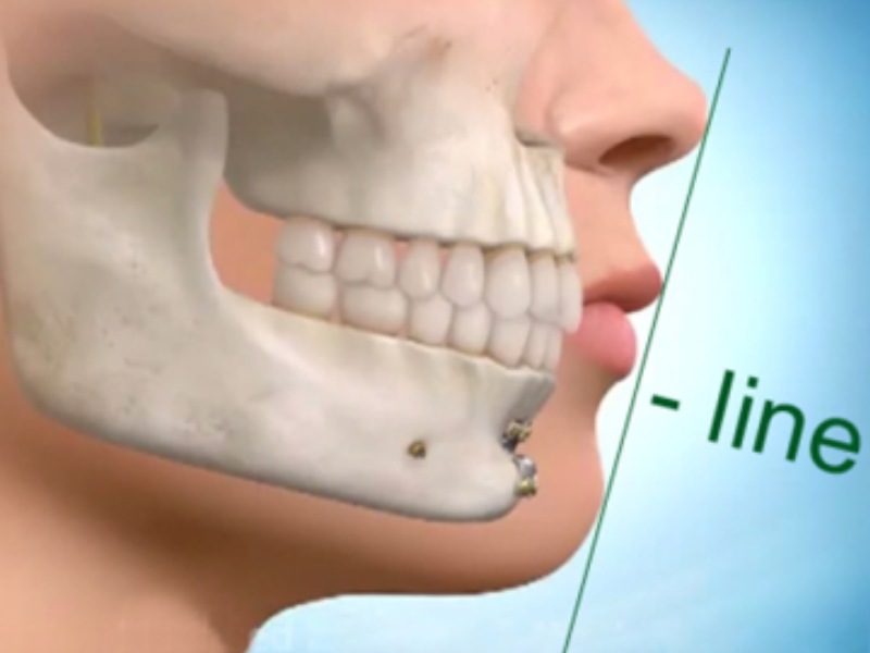 Độn cằm bằng xương tự thân là phương pháp lấy xương từ vị trí khác trên cơ thể để cấy ghép vào cằm
