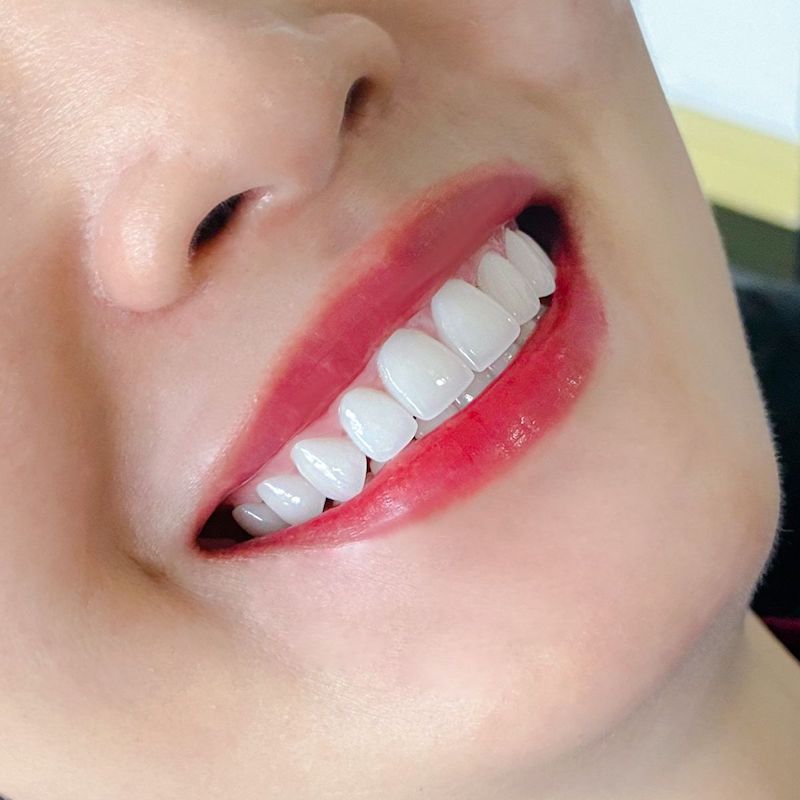 Quy trình bọc răng sứ sẽ diễn ra như thế nào?