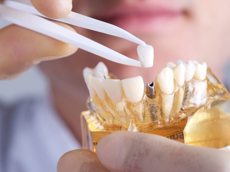 Thiết kế, tạo hình răng sứ phù hợp