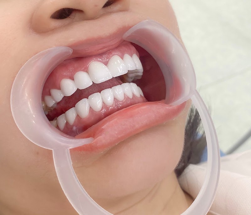 Sau khi kiểm tra xong các bước, bác sĩ tiến hành gắn răng sứ cho khách hàng