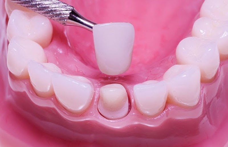 Sau khi chế tác xong, bác sĩ sẽ gắn thử răng sứ để kiểm tra