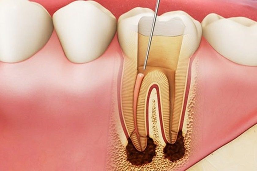 Lấy tủy răng bị sót tủy: Cách phát hiện và khắc phục