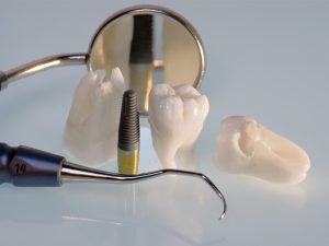 Tình trạng răng khôn mọc lệch có gây nguy hiểm gì không