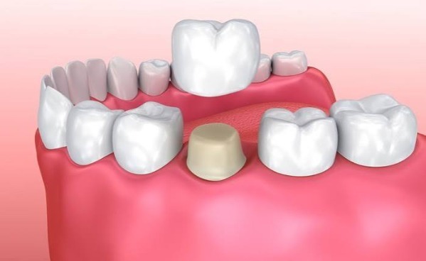 Khi nào bọc răng sứ cần thay mới?