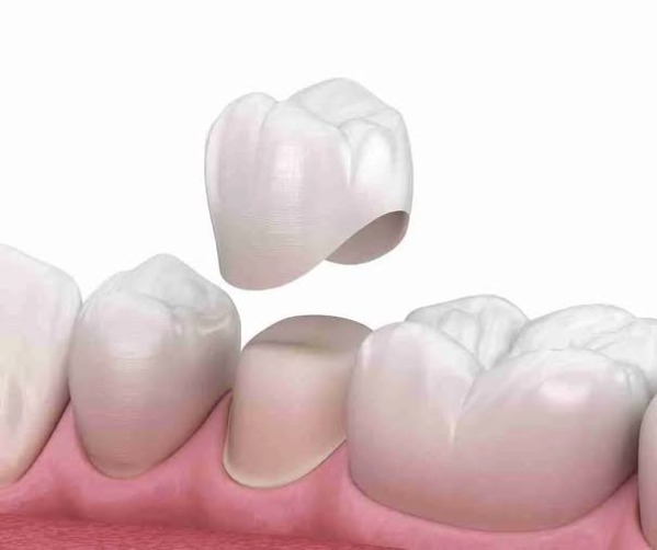 Bọc răng sứ có tuổi thọ bao lâu?
