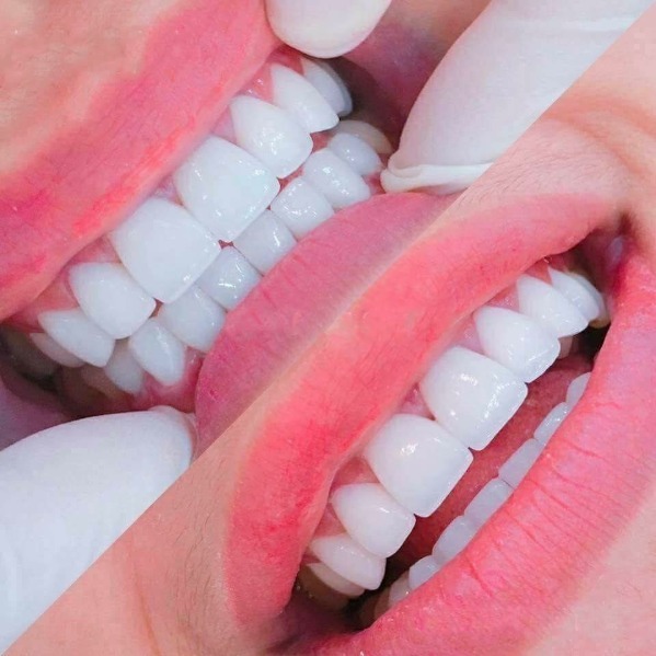 Bọc sứ có tháo được không? Hướng dẫn cách vệ sinh đúng chuẩn