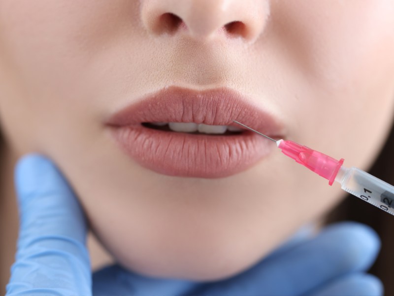 Tiêm filler môi có giá thành dao động trong khoảng từ 3.000.000 - 14.000.000 VNĐ/ cc
