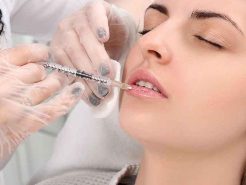Filler trong môi sẽ giữ được từ 1-2 năm