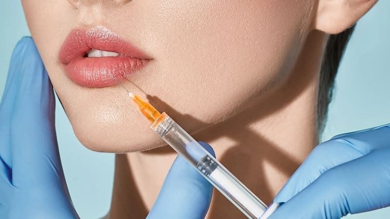 Tiêm filler sử dụng chất làm đầy tiêm vào môi để tạo hình
