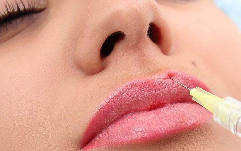 Tiêm filler có mức giá phù hợp và phải chăng