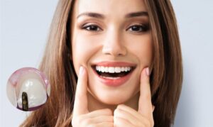 Trám răng Composite là gì? Có tốt không?