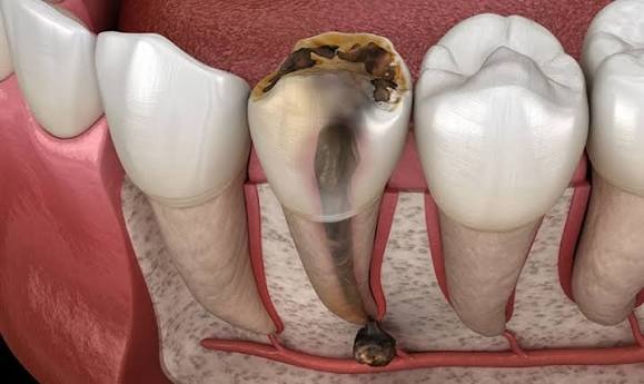 Giảm đau viêm tủy răng nhanh chóng: Cách chữa tại nhà