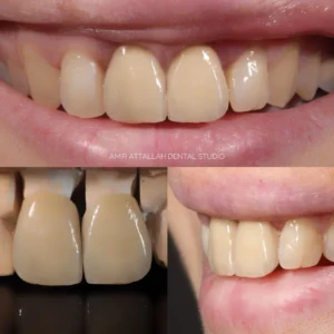 Porcelain crowns MRI safe