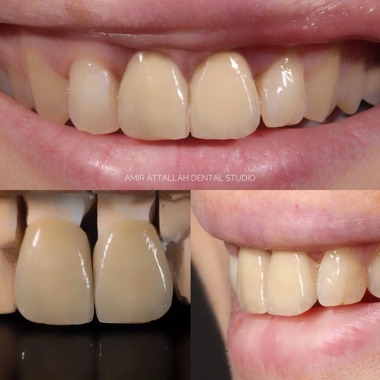 Porcelain crowns MRI safe