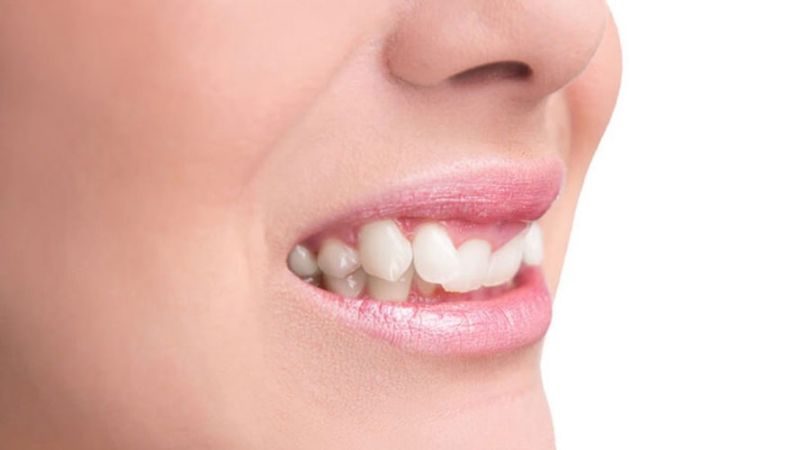 Khớp cắn không đều gây khó khăn khi ăn nhai