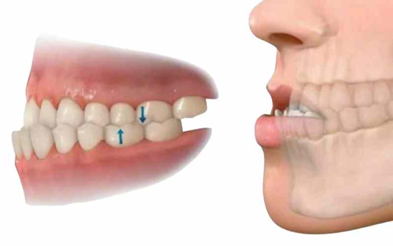 Mặt móm do sự phát triển không đồng đều giữa xương hàm trên và xương hàm dưới