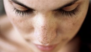 Nám là vùng da nâu hoặc sậm màu trên da