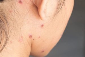 Sẹo do thủy đậu có ở khắp nơi trên cơ thể